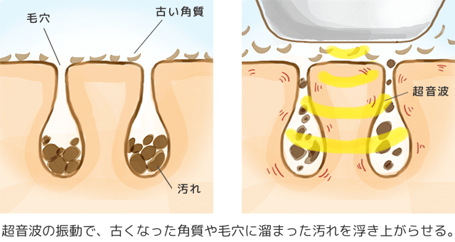 超音波美顔器を利用したクレンジング効果の解図